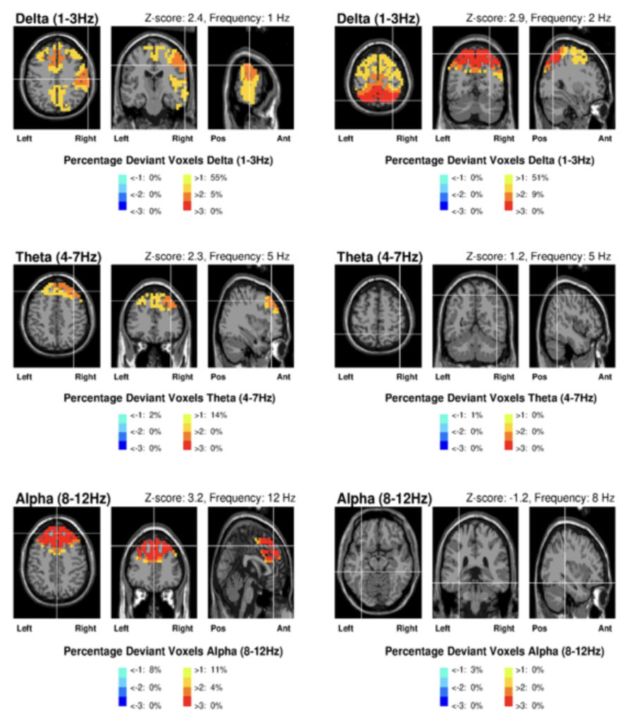 casos reales neurofeedback para autismo ninos con TEA 1